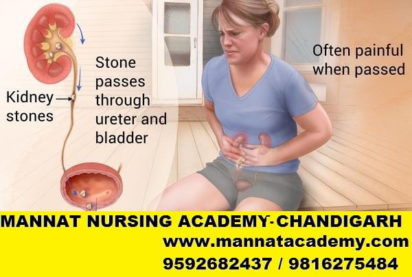 Symptoms of kidney Stones | mannatacademy.com